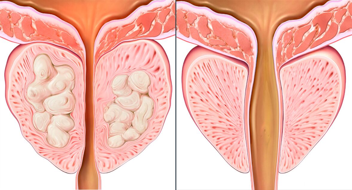 Prostatīta ārstēšanas kursa posmi ar Prostalix